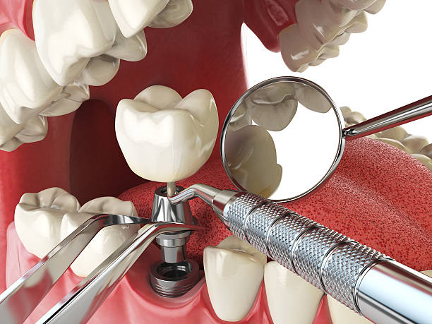 Best Emergency Tooth Extraction in San Rlos, CA